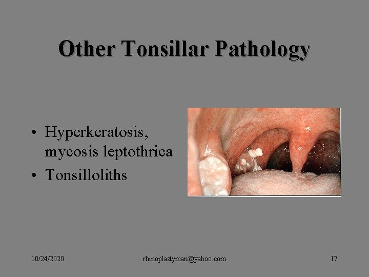 Other Tonsillar Pathology • Hyperkeratosis, mycosis leptothrica • Tonsilloliths 10/24/2020 rhinoplastyman@yahoo. com 17 Other Tonsillar Pathology • Hyperkeratosis, mycosis leptothrica • Tonsilloliths 10/24/2020 rhinoplastyman@yahoo. com 17