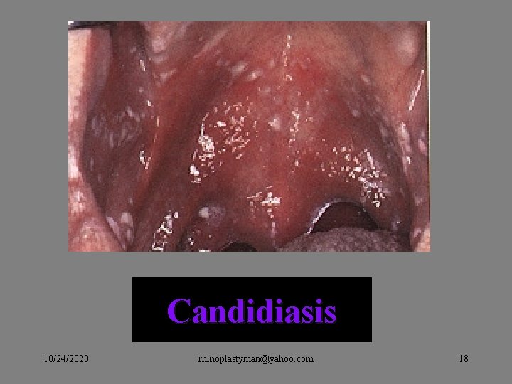 Candidiasis 10/24/2020 rhinoplastyman@yahoo. com 18 Candidiasis 10/24/2020 rhinoplastyman@yahoo. com 18