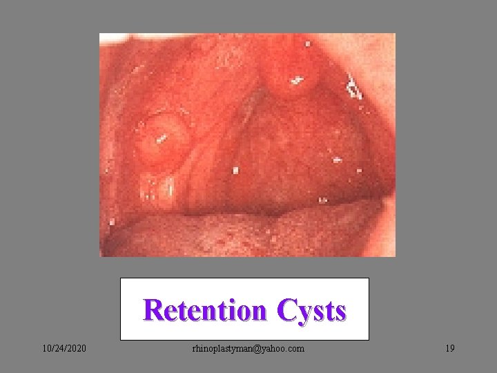 Retention Cysts 10/24/2020 rhinoplastyman@yahoo. com 19 Retention Cysts 10/24/2020 rhinoplastyman@yahoo. com 19