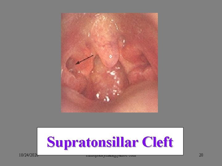Supratonsillar Cleft 10/24/2020 rhinoplastyman@yahoo. com 20 Supratonsillar Cleft 10/24/2020 rhinoplastyman@yahoo. com 20