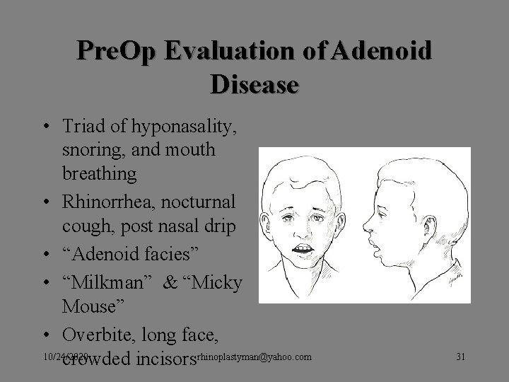 Pre. Op Evaluation of Adenoid Disease • Triad of hyponasality, snoring, and mouth breathing Pre. Op Evaluation of Adenoid Disease • Triad of hyponasality, snoring, and mouth breathing