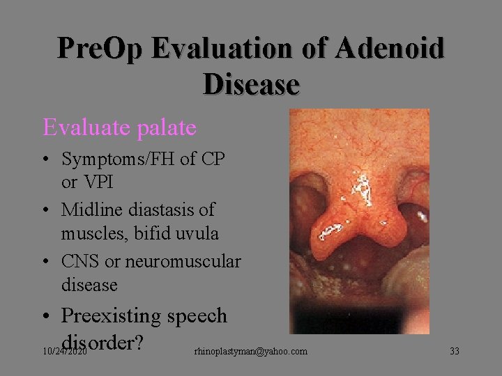 Pre. Op Evaluation of Adenoid Disease Evaluate palate • Symptoms/FH of CP or VPI Pre. Op Evaluation of Adenoid Disease Evaluate palate • Symptoms/FH of CP or VPI