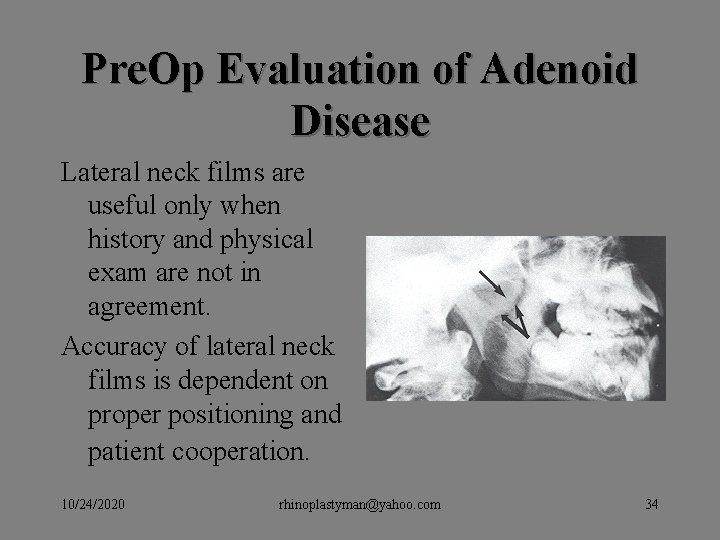 Pre. Op Evaluation of Adenoid Disease Lateral neck films are useful only when history Pre. Op Evaluation of Adenoid Disease Lateral neck films are useful only when history