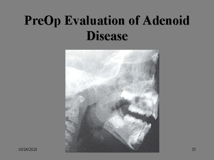 Pre. Op Evaluation of Adenoid Disease 10/24/2020 rhinoplastyman@yahoo. com 35 Pre. Op Evaluation of Adenoid Disease 10/24/2020 rhinoplastyman@yahoo. com 35
