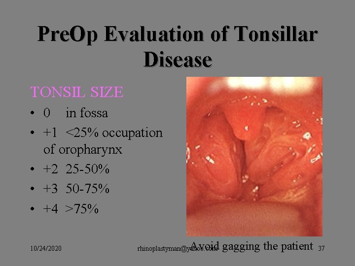 Pre. Op Evaluation of Tonsillar Disease TONSIL SIZE • 0 in fossa • +1 Pre. Op Evaluation of Tonsillar Disease TONSIL SIZE • 0 in fossa • +1