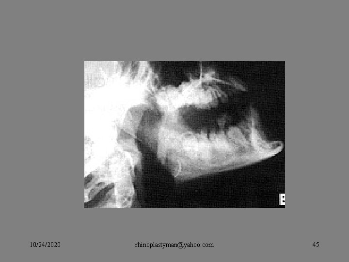 10/24/2020 rhinoplastyman@yahoo. com 45 10/24/2020 rhinoplastyman@yahoo. com 45