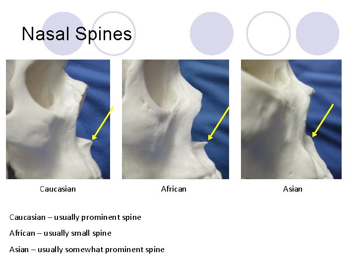 Nasal Spines Caucasian African Caucasian – usually prominent spine African – usually small spine