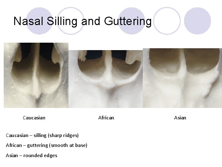 Nasal Silling and Guttering Caucasian – silling (sharp ridges) African – guttering (smooth at