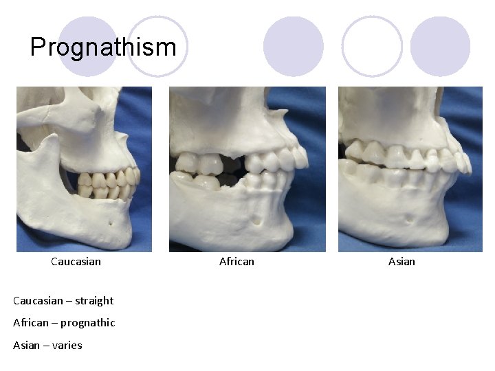 Prognathism Caucasian – straight African – prognathic Asian – varies African Asian 