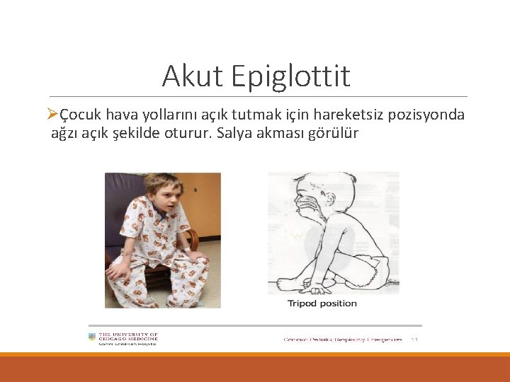 Akut Epiglottit ØÇocuk hava yollarını açık tutmak için hareketsiz pozisyonda ağzı açık şekilde oturur.