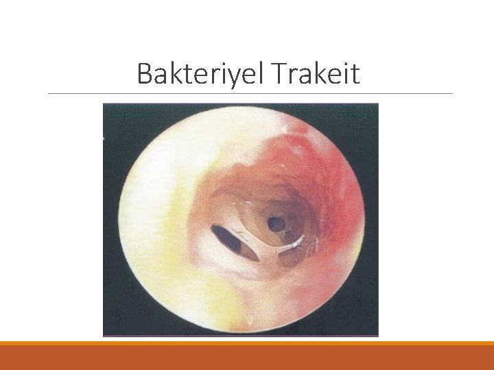 Bakteriyel Trakeit 