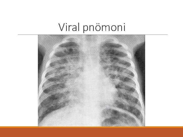 Viral pnömoni 