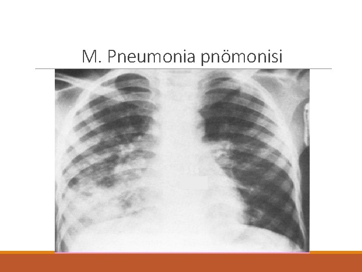 M. Pneumonia pnömonisi 