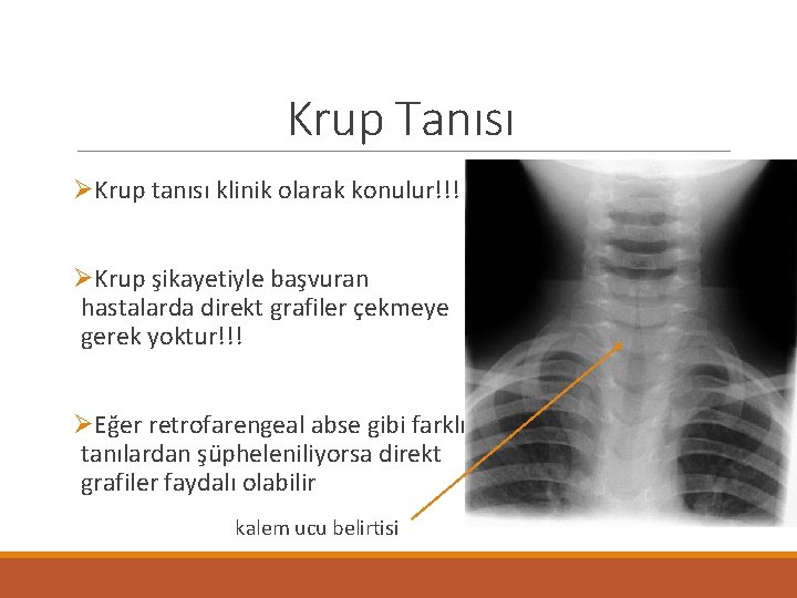 Krup Tanısı ØKrup tanısı klinik olarak konulur!!! ØKrup şikayetiyle başvuran hastalarda direkt grafiler çekmeye