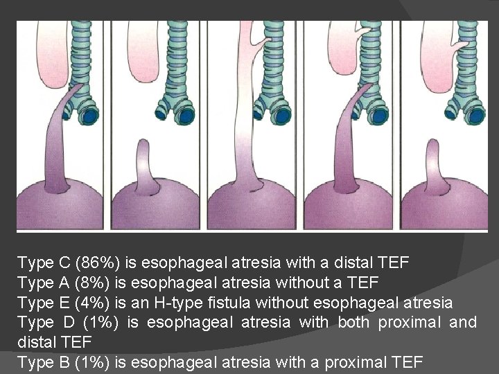 Type C (86%) is esophageal atresia with a distal TEF Type A (8%) is