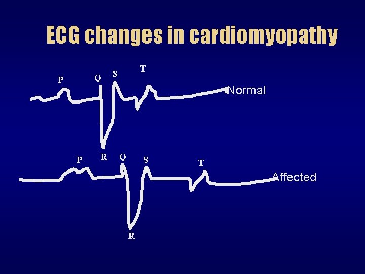 ECG changes in cardiomyopathy Q P T S Normal P R Q S T