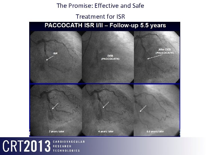 The Promise: Effective and Safe Treatment for ISR DEB (PACCOCATH) ISR 2 Years F/u