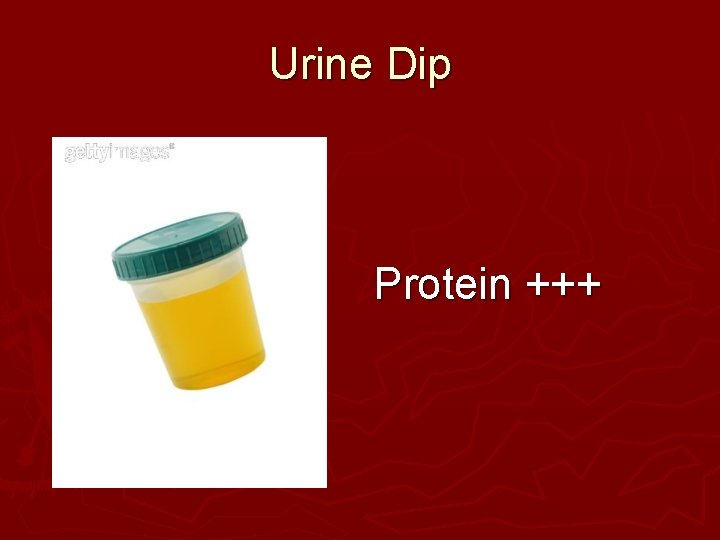 Urine Dip Protein +++ Urine Dip Protein +++