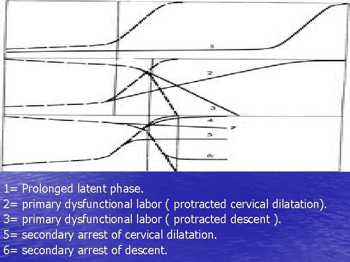 1= 2= 3= 5= 6= Prolonged latent phase. primary dysfunctional labor ( protracted cervical