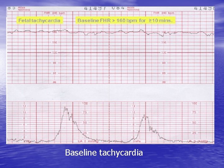 Baseline tachycardia 