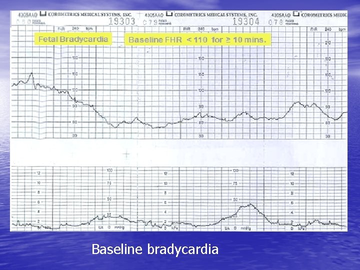 Baseline bradycardia 