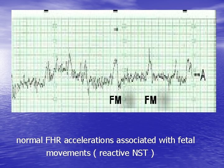 normal FHR accelerations associated with fetal movements ( reactive NST ) 