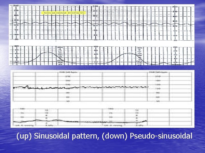(up) Sinusoidal pattern, (down) Pseudo-sinusoidal 