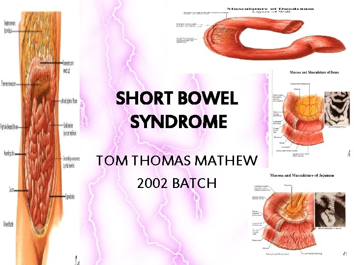 SHORT BOWEL SYNDROME TOM THOMAS MATHEW 2002 BATCH 