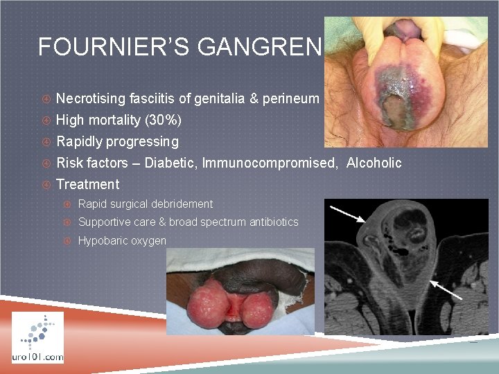 FOURNIER’S GANGRENE Necrotising fasciitis of genitalia & perineum High mortality (30%) Rapidly progressing Risk