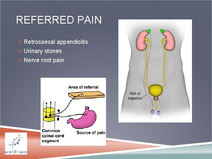 REFERRED PAIN Retrocaecal appendicitis Urinary stones Nerve root pain 