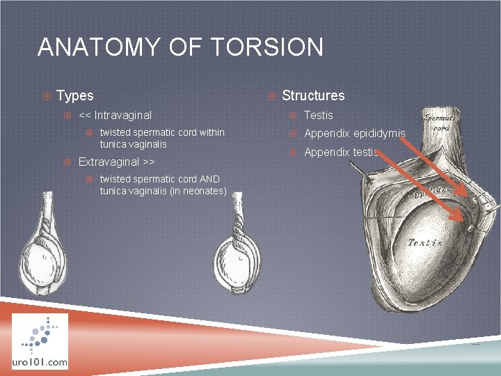 ANATOMY OF TORSION Types Structures << Intravaginal twisted spermatic cord within tunica vaginalis Extravaginal