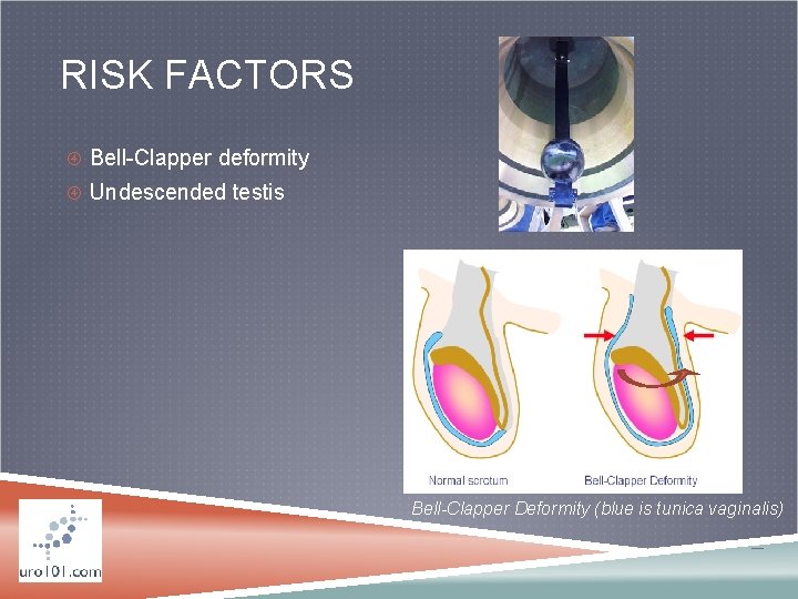 RISK FACTORS Bell-Clapper deformity Undescended testis Bell-Clapper Deformity (blue is tunica vaginalis) 