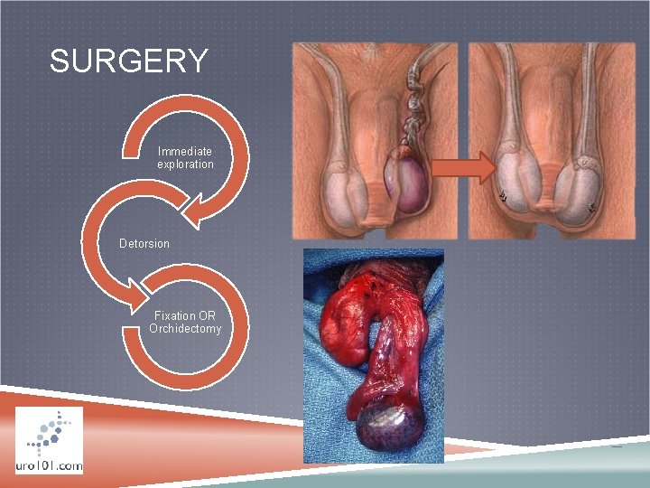 SURGERY Immediate exploration Detorsion Fixation OR Orchidectomy 