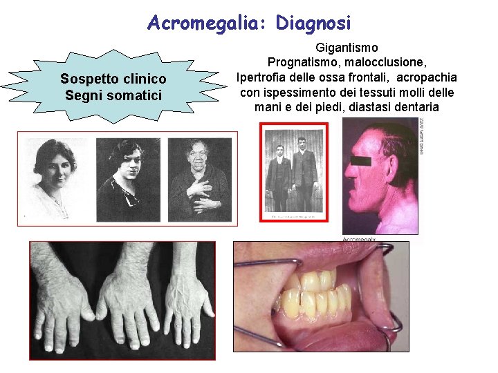 Acromegalia: Diagnosi Sospetto clinico Segni somatici Gigantismo Prognatismo, malocclusione, Ipertrofia delle ossa frontali, acropachia