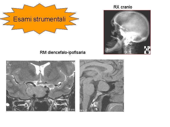 RX cranio Esami strumentali RM diencefalo-ipofisaria 