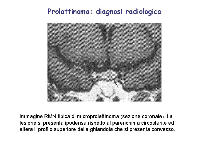 Prolattinoma: diagnosi radiologica Immagine RMN tipica di microprolattinoma (sezione coronale). La lesione si presenta