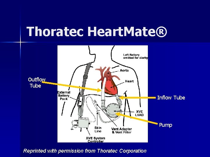 Thoratec Heart. Mate® Outflow Tube Inflow Tube Pump Reprinted with permission from Thoratec Corporation