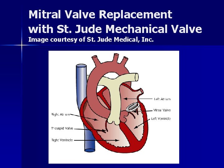 Mitral Valve Replacement with St. Jude Mechanical Valve Image courtesy of St. Jude Medical,