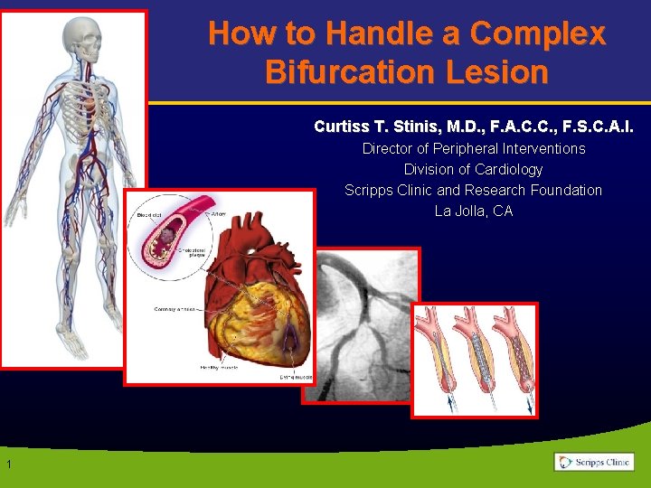 How to Handle a Complex Bifurcation Lesion Curtiss T. Stinis, M. D. , F.