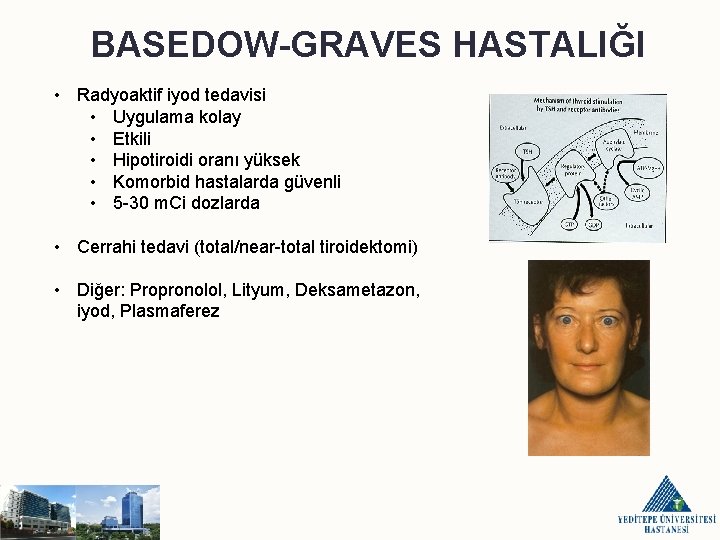 BASEDOW-GRAVES HASTALIĞI • Radyoaktif iyod tedavisi • Uygulama kolay • Etkili • Hipotiroidi oranı