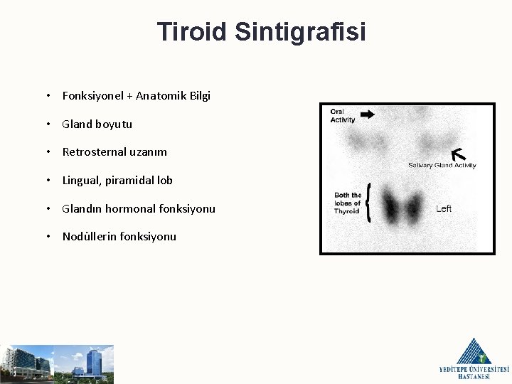 Tiroid Sintigrafisi • Fonksiyonel + Anatomik Bilgi • Gland boyutu • Retrosternal uzanım •