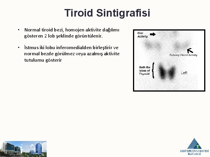 Tiroid Sintigrafisi • Normal tiroid bezi, homojen aktivite dağılımı gösteren 2 lob şeklinde görüntülenir.