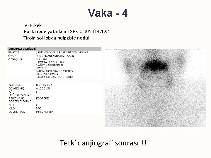 Vaka - 4 66 Erkek Hastanede yatarken TSH< 0. 005 f. T 4: 1.