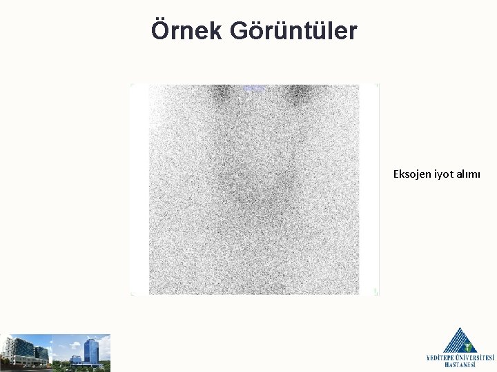 Örnek Görüntüler Eksojen iyot alımı 