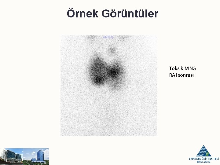 Örnek Görüntüler Toksik MNG RAI sonrası 