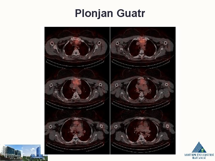 Plonjan Guatr 