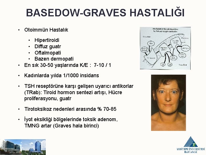 BASEDOW-GRAVES HASTALIĞI • Otoimmün Hastalık • Hipertiroidi • Diffuz guatr • Oftalmopati • Bazen
