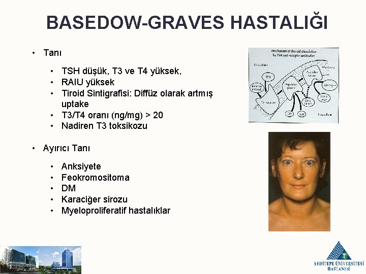 BASEDOW-GRAVES HASTALIĞI • Tanı • TSH düşük, T 3 ve T 4 yüksek, •