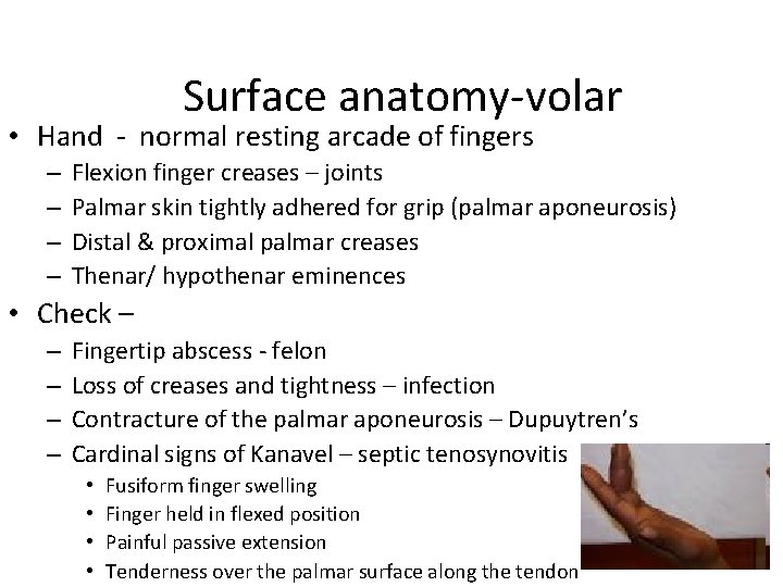 Surface anatomy-volar • Hand - normal resting arcade of fingers – – Flexion finger