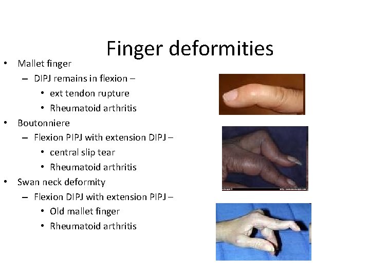 Finger deformities • Mallet finger – DIPJ remains in flexion – • ext tendon